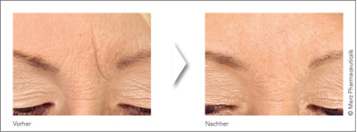 Vorher-Nachher