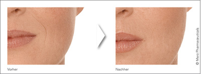 Vorher-Nachher