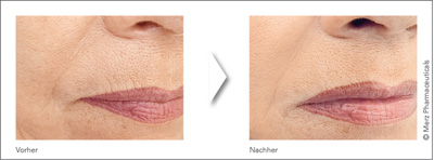 Vorher-Nachher